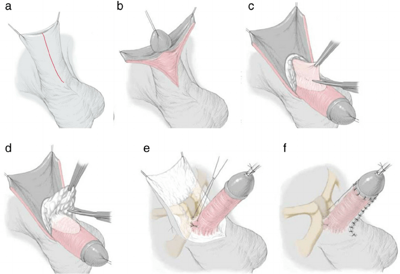 ligamentotomía para agrandamento do pene